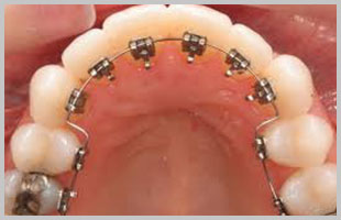 Lingual Tedavi Tekniği